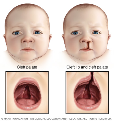 617-fl7_cleft_palate